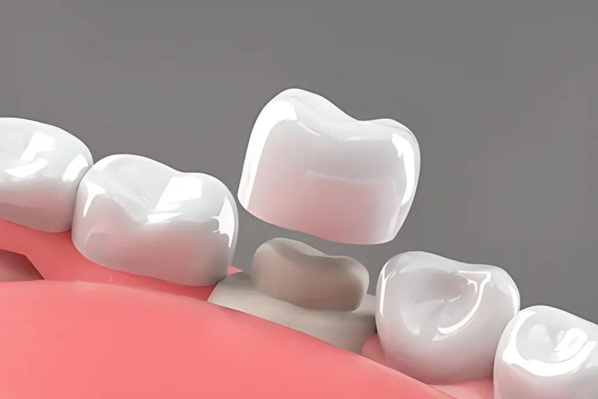 How Much Do Dental Crowns Cost