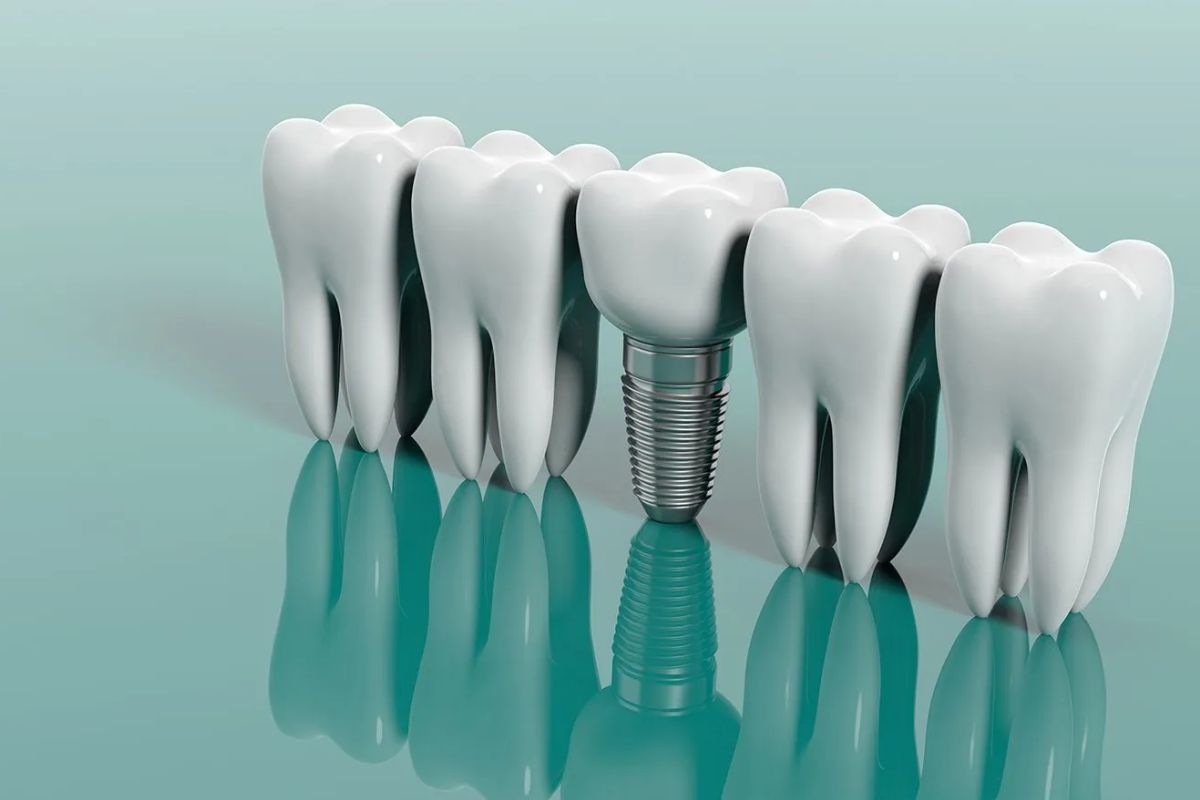 dental-implants-everything-you-need-to-know