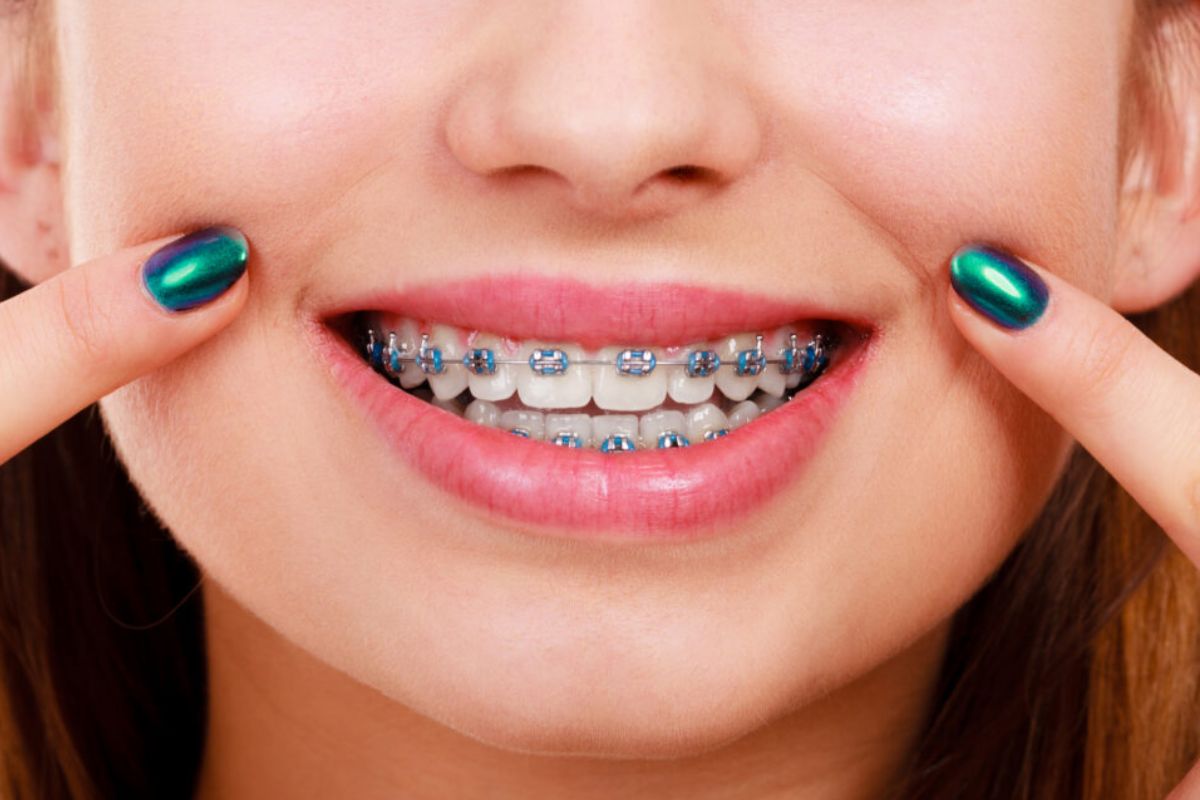 the-impact-of-braces-on-your-appearance