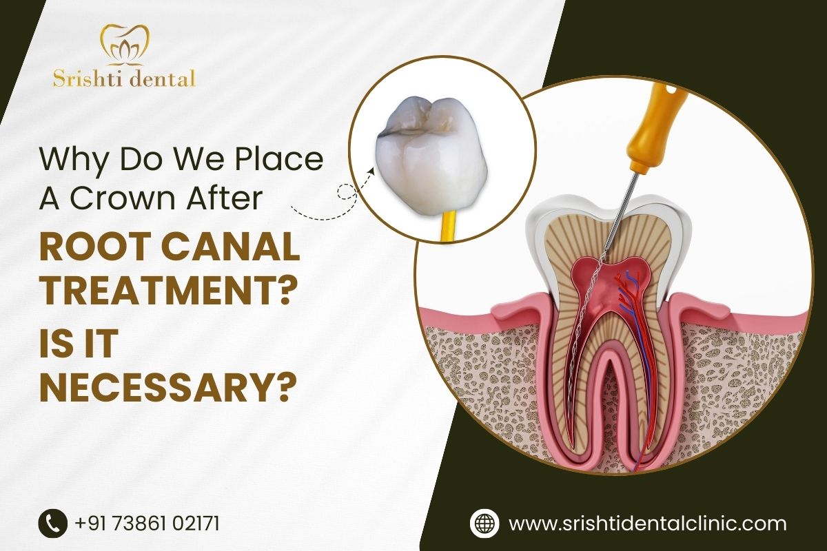 why-do-we-place-a-crown-after-root-canal-treatment